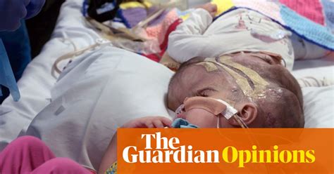 Separating Conjoined Twins Is A Stressful High Risk Operation Its
