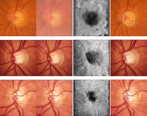 Three Pairs Of Stereoscopic Optic Disc Photographs And Their Disparity