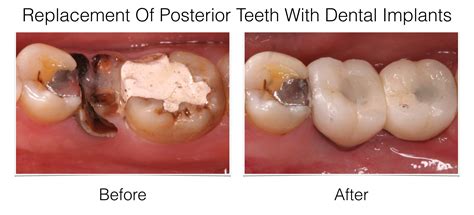 Are Teeth Considered Bones TeethWalls