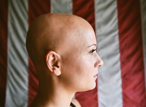Alopecia Universalis — Living For Everything