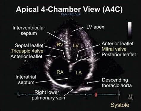 Apical 4 Chamber View Tee Diagnostic Medical Sonography Cardiac