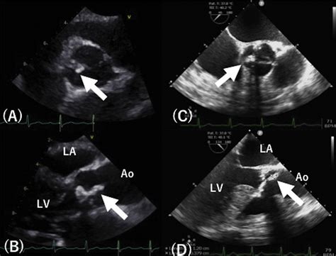 A Calcified Amorphous Tumor Originating In The Aortic Valve Cusp The Annals Of Thoracic Surgery