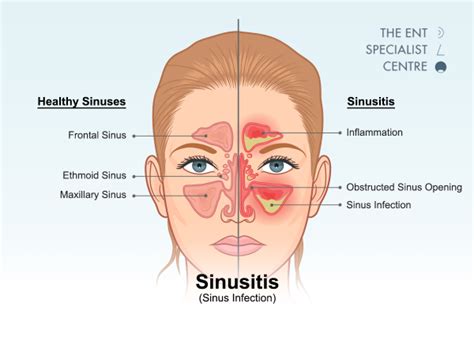 Sinus Conditions Sinus Clinic