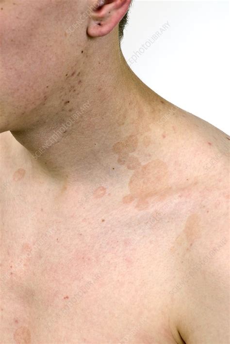 All About Tinea Versicolor Causes Treatment And Prevention 55 Off