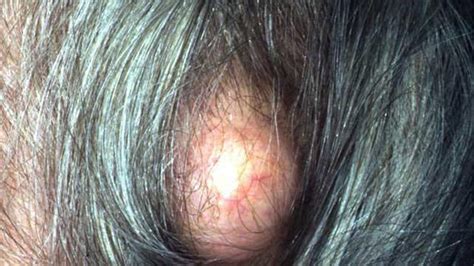 Bump On The Back Of The Head Causes And When To See A Doctor