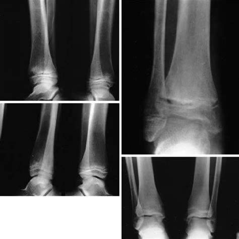 Normal Growth Plate Of The Distal Tibia Which Is Curved And After