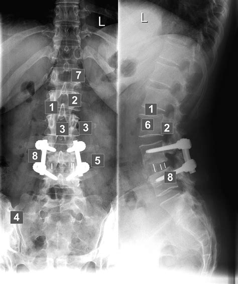 Image Quality In Conventional Lumbar Spine Radiography European Journal Of Radiology
