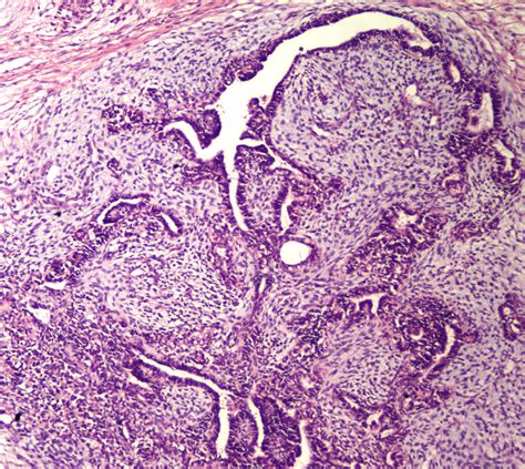 Uropatología En Línea Masa Testicular En Paciente De 5 Meses