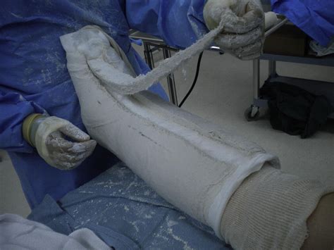 Univalve Split Plaster Cast For Postoperative Immobilization In Foot
