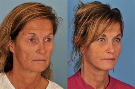 facelift neck lift before and after pictures case 164 toronto on ford plastic surgery dr