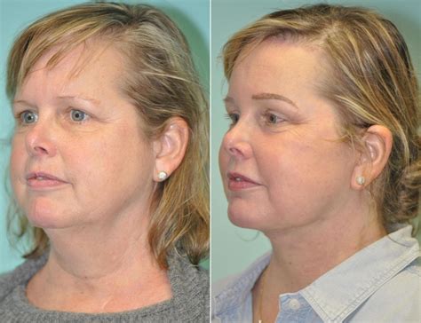 She underwent upper blepharoplasty (eyelid lift), lower blepharoplasty (transconjunctival with fat repositioning and skin pinch removal) and lateral pretrichial brow lift (using temple hairline incision). Brow Lift photos | Chevy Chase, MD | Patient 13875
