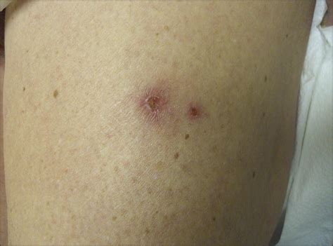 Pruritic Maculopapular Dermatitis In A Household—quiz Case