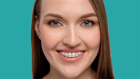 Braces For Adults More Adults Are Getting Perfect Smiles With Braces