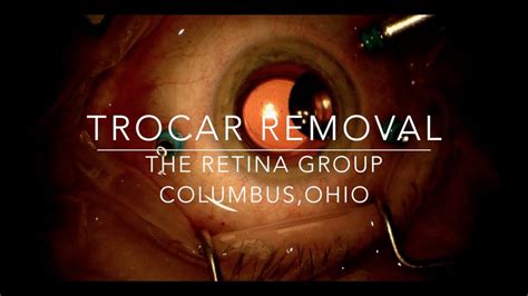 Trocar Removal During 25 Gauge Vitrectomy Surgery Youtube