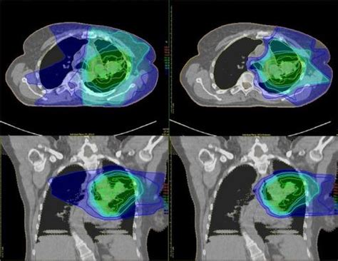 Lung Cancer Radiation Treatment