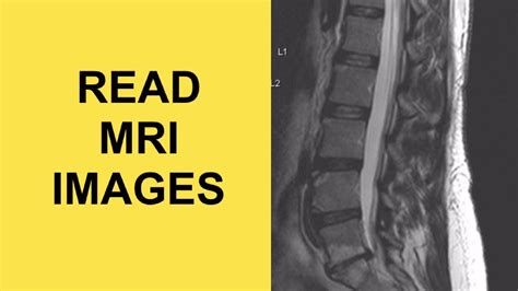 How To Read An Mri Of The Lumbar Spine For Herniated Discs Sciatica