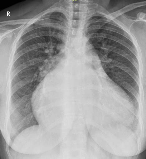 Biatrial Enlargement On Cxr All About Cardiovascular System And Disorders