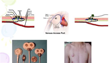 Central Venous Access Device Cvad Youtube