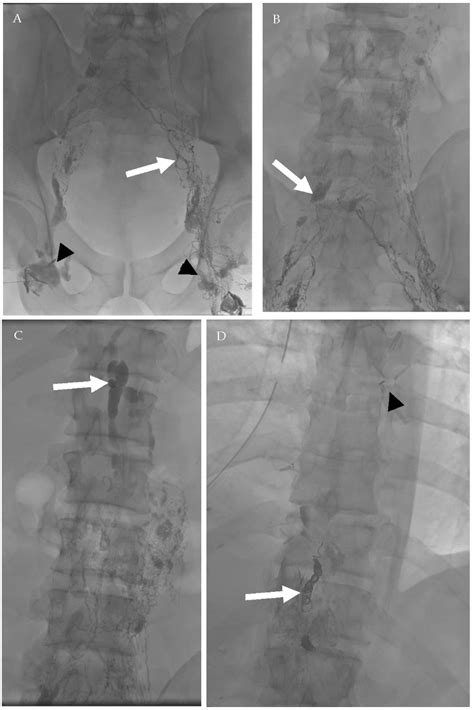 Cancers Free Full Text Oncologic Imaging Of The Lymphatic System