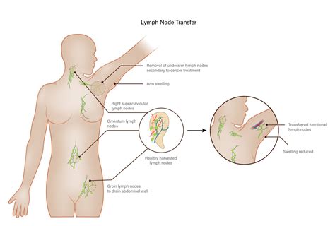 Why Remove Lymph Nodes