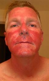 Levulan Blue Light Treatment For Skin Cancer Pictures