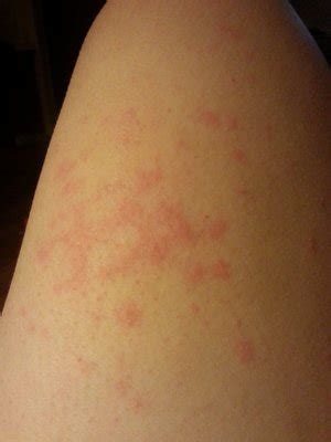 Scaly Itchy Red Bumps On Arms