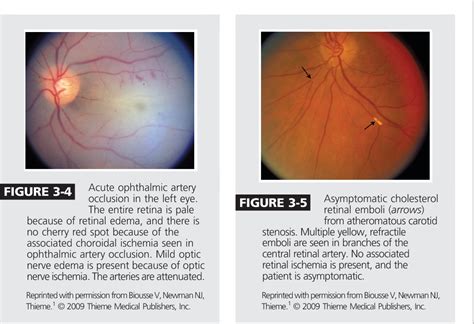 Figure 3 17 From Retinal And Optic Nerve Ischemia Semantic Scholar