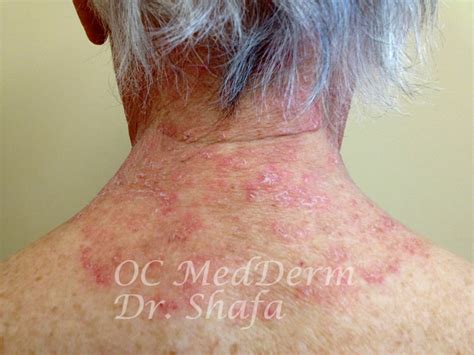 Eczema Treatment Irvine And Orange County Oc Medderm