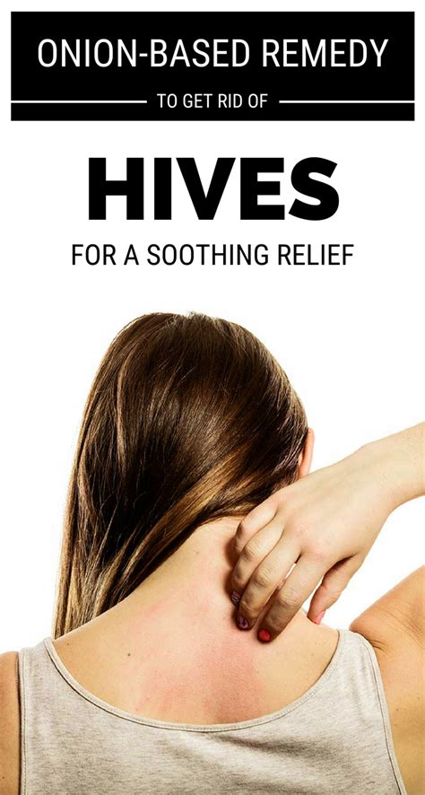 Onion Based Remedy To Get Rid Of Hives For A Soothing Relief Hives