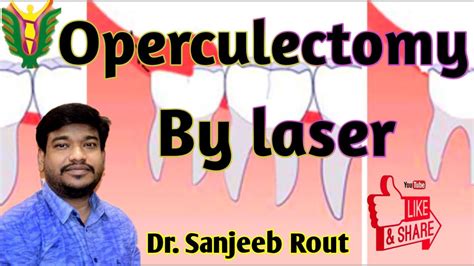 Operculectomy By Laser Dr Sanjeeb Rout Youtube