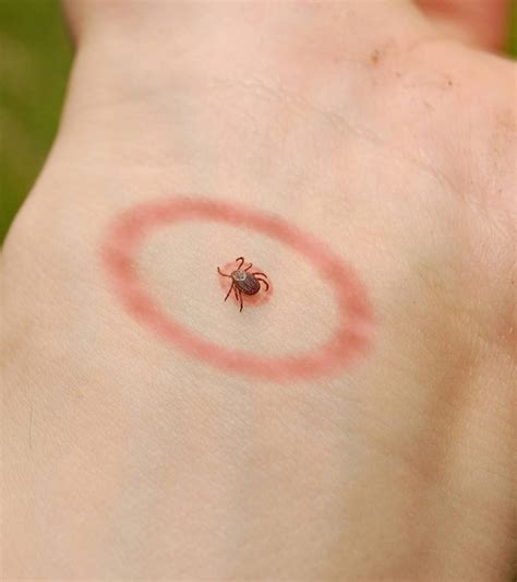 Lyme Disease In Toddlers Symptoms And Treatments You Should Be Aware Of