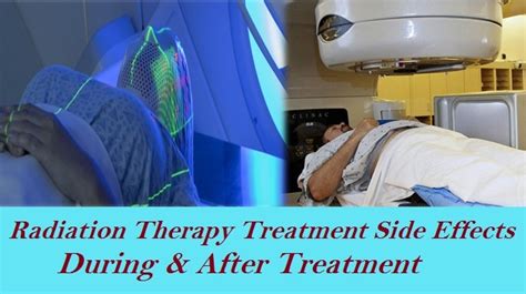 Radiation Therapy Treatment Side Effects During And After Treatment