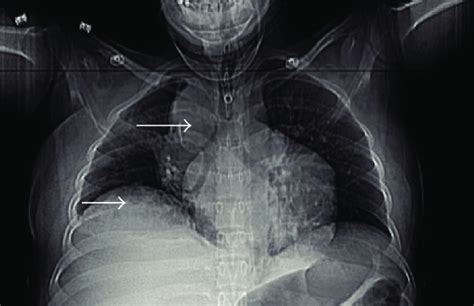 Chest X Ray Right Paratracheal Soft Tissue Opacity Measuring