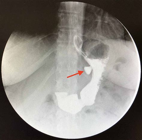 Cureus A Strong Approach To A Weak Gastric Wall In Bariatric Surgery