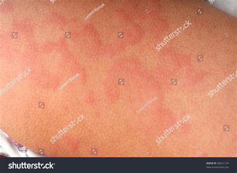 Close Up Image Of A Little Boys Body Suffering Severe Urticaria