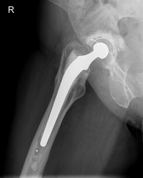 Implant Loosening2 Manchester Hip Clinic