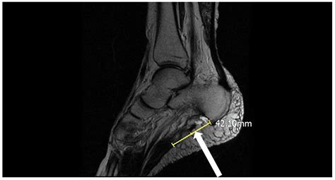 Medicina Free Full Text Surgical Reconstruction With Tendon