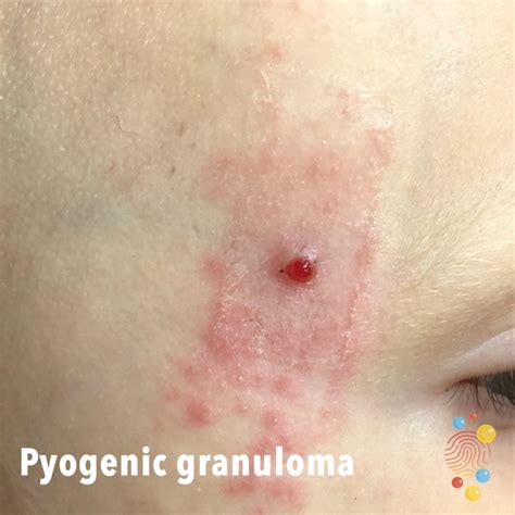 Pyogenic Granuloma Skin Deep