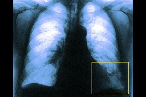 Embolia Pulmonar S Ntomas Causas Y Tratamiento
