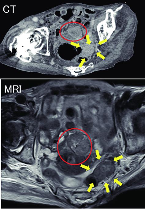 Contrast Enhanced Ct And T2 Weighted Mri Showing Two Tumors One Of