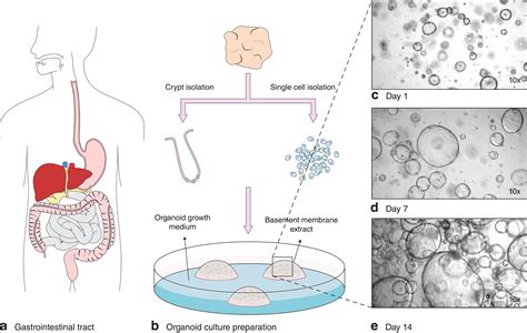 Patient‐derived Organoid Models Help Define Personalized Management Of