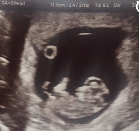 8 Weeks Scans Can I See Your Pictures Please Netmums Chat