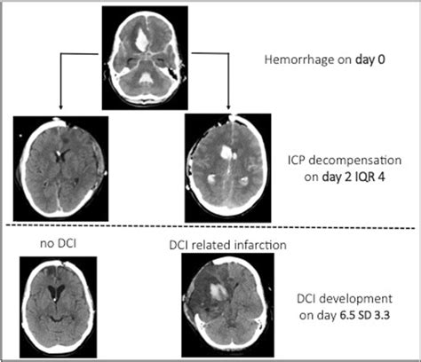 Depiction Of The Timely Relation Between Decompensation Of Intracranial