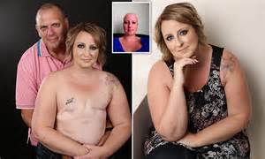 Breast Cancer Survivor Poses Topless After Double Mastectomy Daily