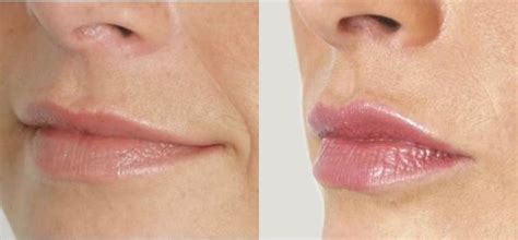 Lip Augmentation Nyc 212 644 6454 Nyc Lip Augmentation New York Ny