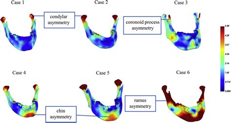 Automated Assessment Of Mandibular Shape Asymmetry In 3 Dimensions