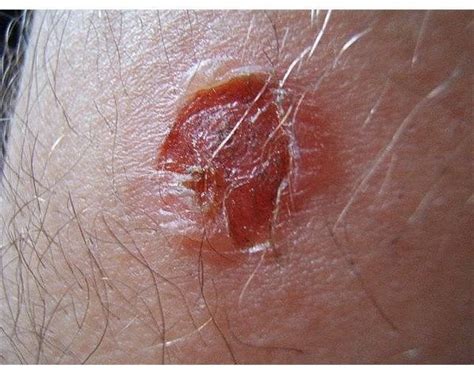 Causes And Natural Treatment Of Impetigo In Elderly Adults