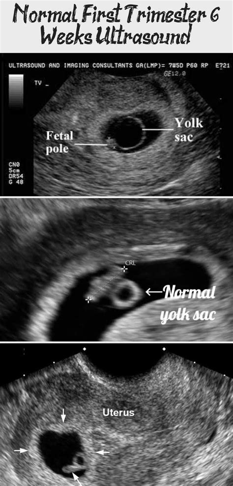 Normal First Trimester 6 Weeks Ultrasound Ultrasoundfeminsider Pregnancy1stt Pregnancy