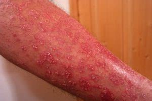 Dermatite Da Stress Ecco Quali Sono Le Cause E Le Cure BN Magazine