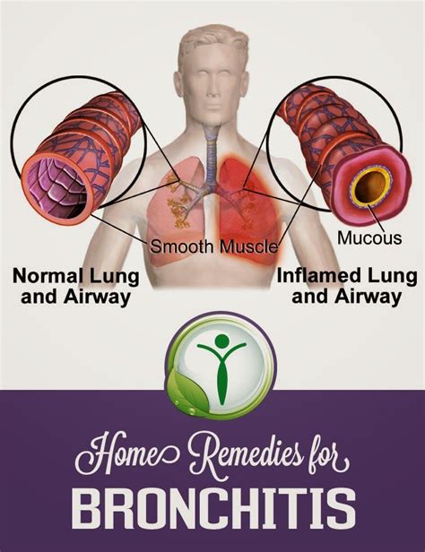 Home Remedies For Bronchitis Ailmentsremedy Home Remedies For